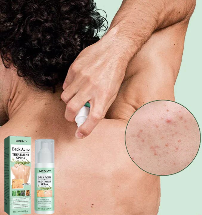 Back Acne Treatment Spray