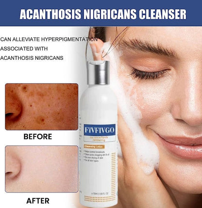 Cleansing Lotion for Acne & Pimples & Acanthosis Nigricans