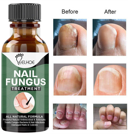 Nail Fungus Solution