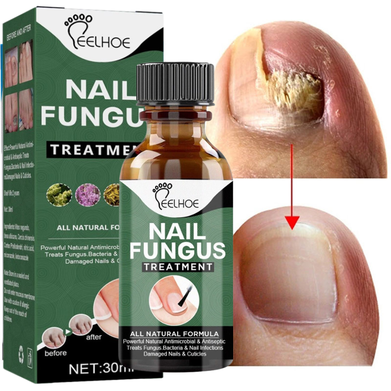 Nail Fungus Solution