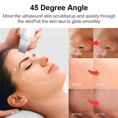 Ultrasonic Skin Scrubber – Facial Deep Cleansing & Blackhead Remover with Stainless Steel Head