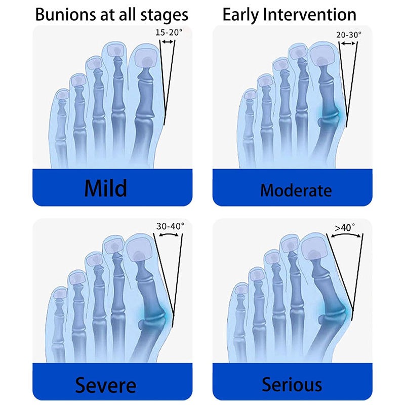 Bunion Fix Toe Valgus Corrector – Adjustable Orthosis Splint for Pain Relief & Alignment
