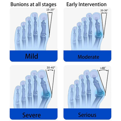 Bunion Fix Toe Valgus Corrector – Adjustable Orthosis Splint for Pain Relief & Alignment