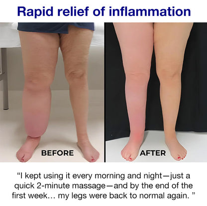 Leg Care Cream – Soothes Swelling, Inflammation & Discomfort