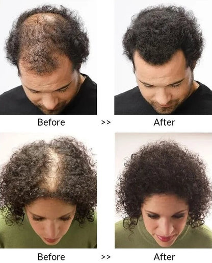Fivfivgo™ ACT Minoxi Roll-On Hair treatment