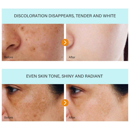 Spot Cream Melasma Remover – 30g Dark Spot & Freckle Corrector