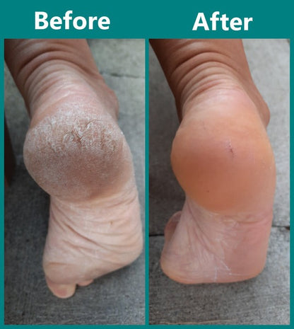 Rechargeable Electric Callus Remover