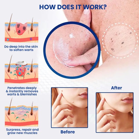 Fivfivgo™ WartsOff Instant Blemish Removal Cream