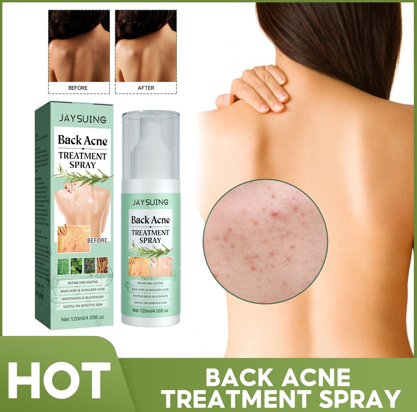 Back Acne Treatment Spray