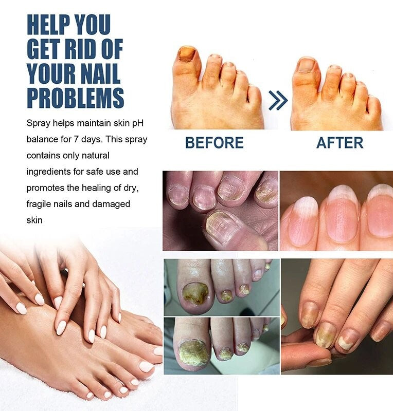 Medica™ Grade Anti-Fungal Nail Treatment Spray