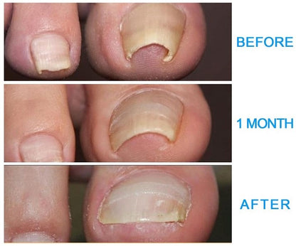 German ToenailPlus™ Anti Paronychia Relief Oil
