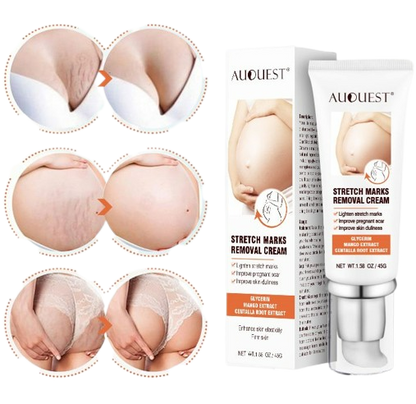 DERMEASE™ Stretchmarks Removal Cream