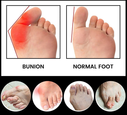Orthoes™ Bunion Relief Socks