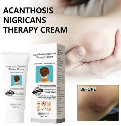 Acanthosis™ Nigricans Therapy Cream