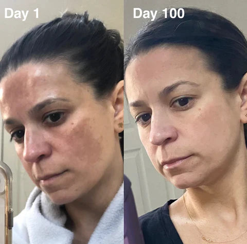Fivfivgo® TripleAction Vitamin C Freckle Removal Cream