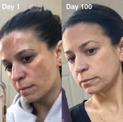 Fivfivgo® TripleAction Vitamin C Freckle Removal Cream