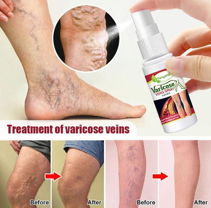 Herbal Varicose Vein Spray
