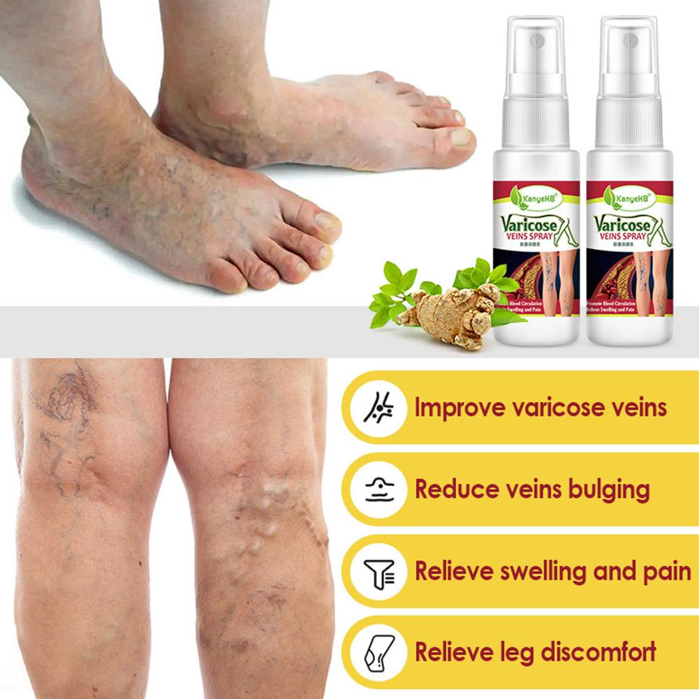 Herbal Varicose Vein Spray