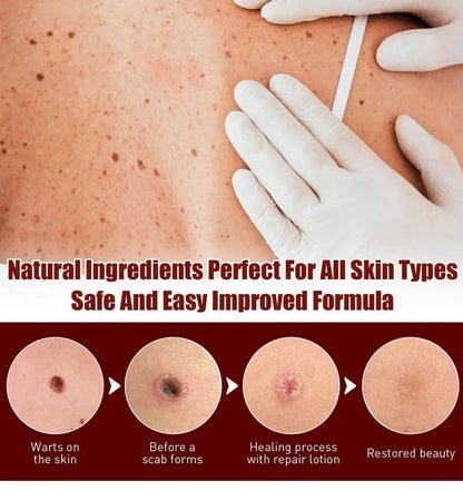 SkinClear™ - Warts and Spots Remover (1+1 FREE)