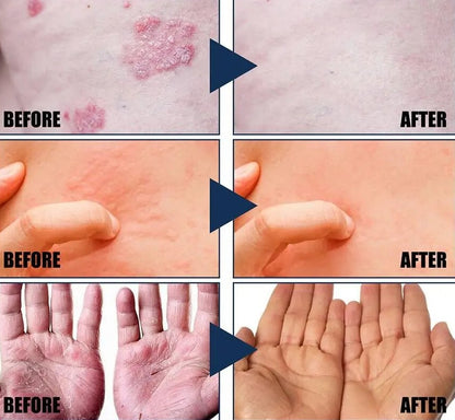 Dermax™ Psoriasis Treatment Spray PRO