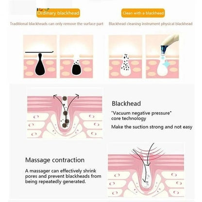 Vacuum Blackhead Remover – Gentle Pore Cleansing Facial Tool