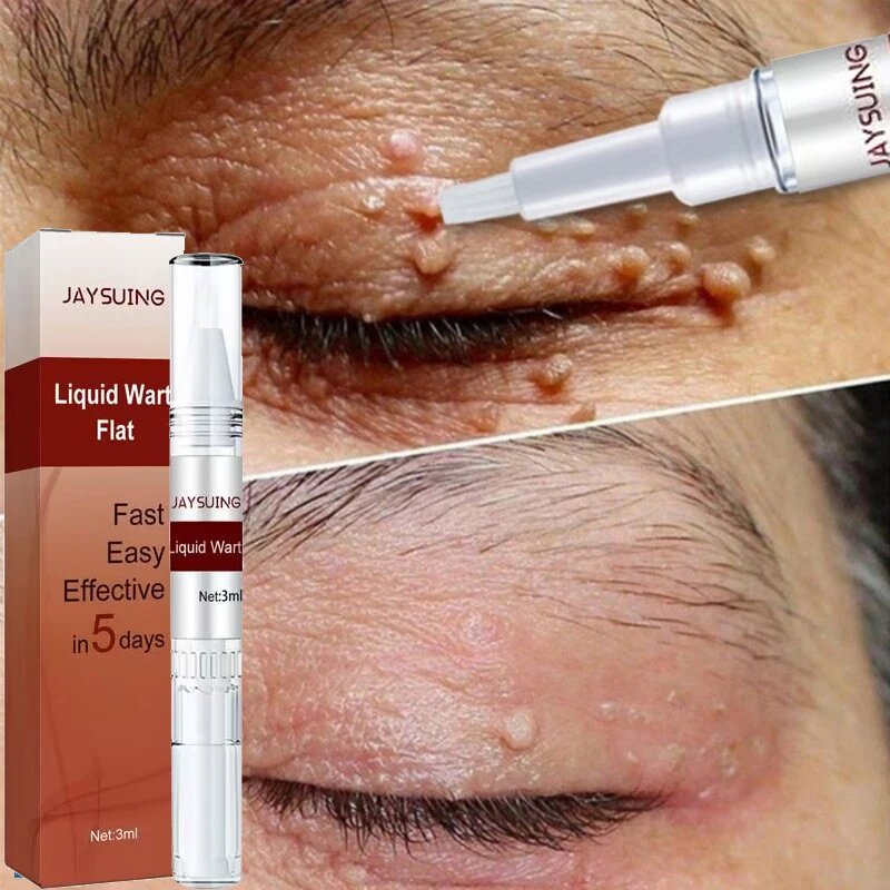 SkinClear™ - Warts and Spots Remover (1+1 FREE)