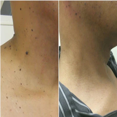 Wart Instant Blemish Cream