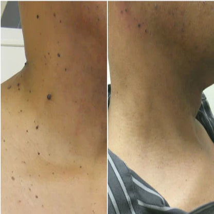 Wart Instant Blemish Cream