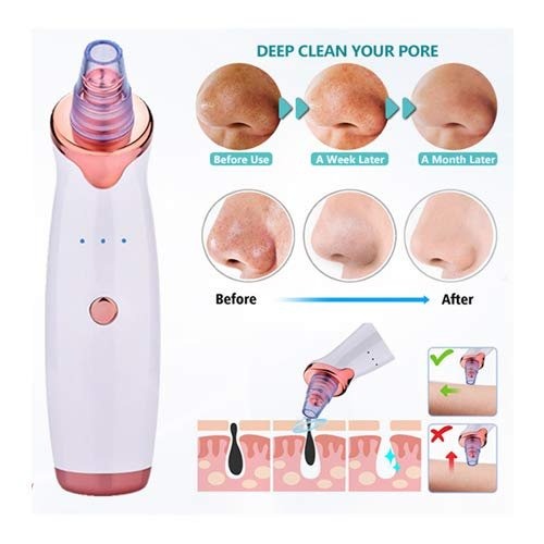 Vacuum Blackhead Remover – Gentle Pore Cleansing Facial Tool