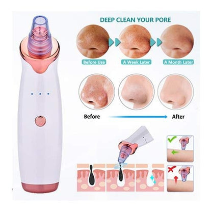 Vacuum Blackhead Remover – Gentle Pore Cleansing Facial Tool