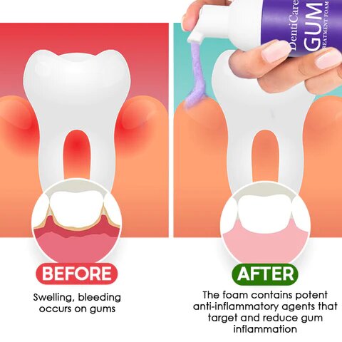 DentiCare™ Gum Treatment Foam