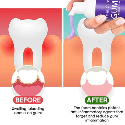 DentiCare™ Gum Treatment Foam
