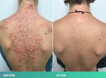 Back Acne Treatment Spray