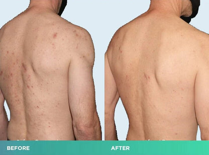 Back Acne Treatment Spray