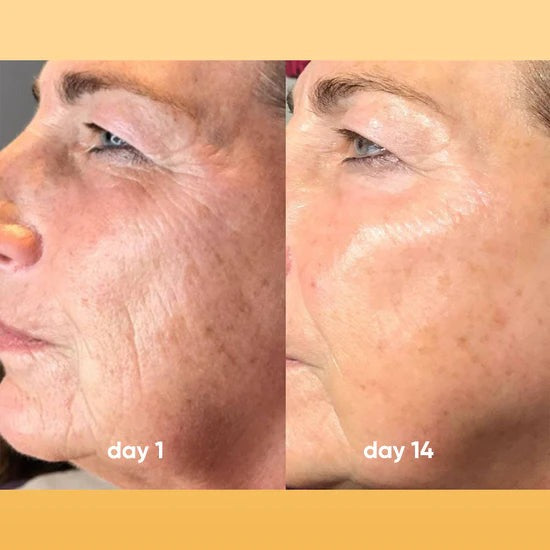 Exfoliating Turmeric Kojic acid pads - Reveal Your Radiant Skin