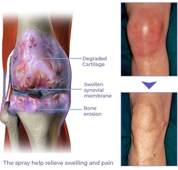 ORIGINAL - New Japanese spray for joint pain and body aches