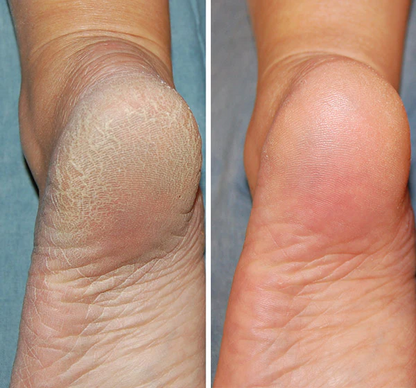 Deep Hydration Hand & Foot Balm Stick – Moisturizing Heel Care