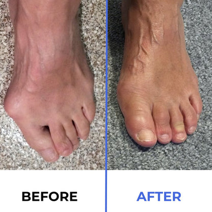 Bunion Fix Toe Valgus Corrector – Adjustable Orthosis Splint for Pain Relief & Alignment