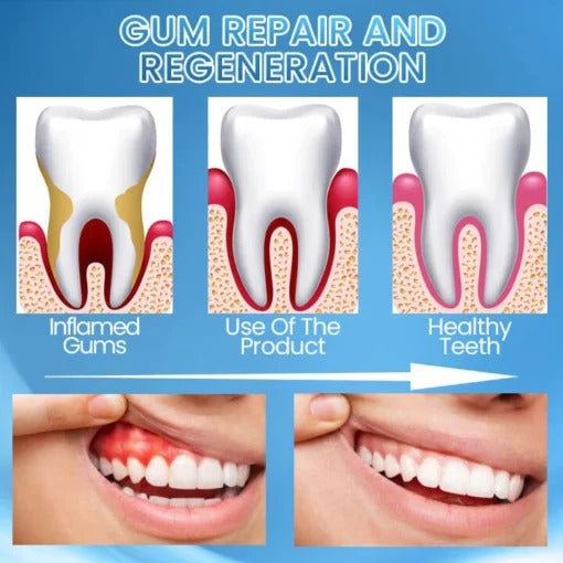 Gum Restoration Whitening Strips