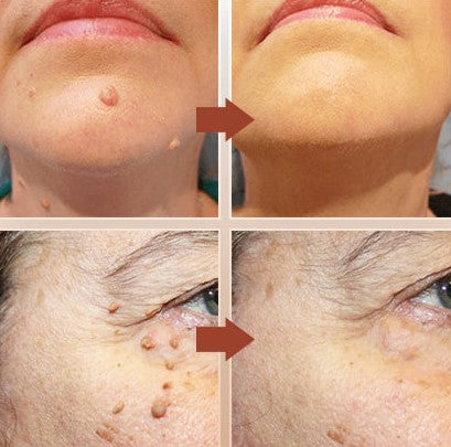 SkinClear™ - Warts and Spots Remover (1+1 FREE)
