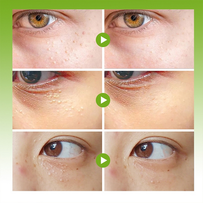 Eye Milia Removal Cream Sumifun