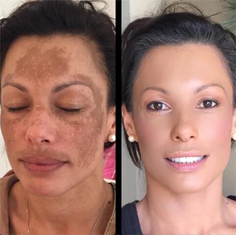 Cleansing Lotion for Acne & Pimples & Acanthosis Nigricans
