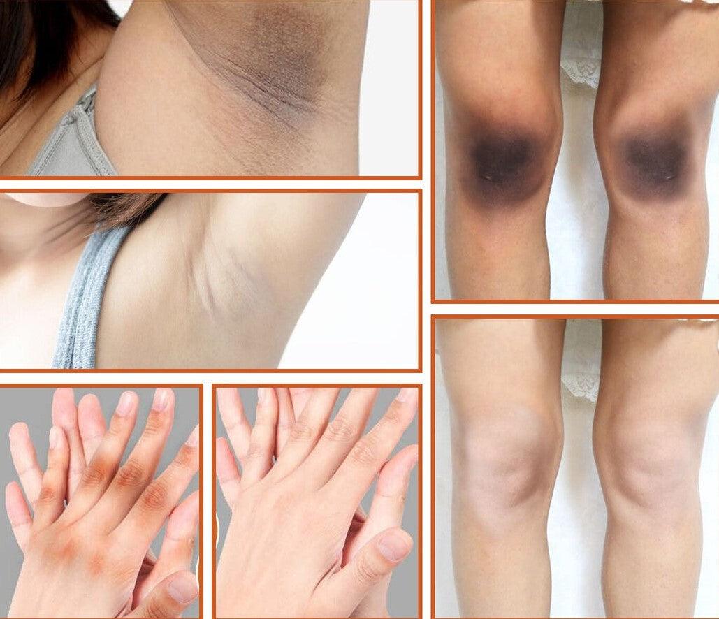 Acanthosis™ Nigricans Therapy Cream