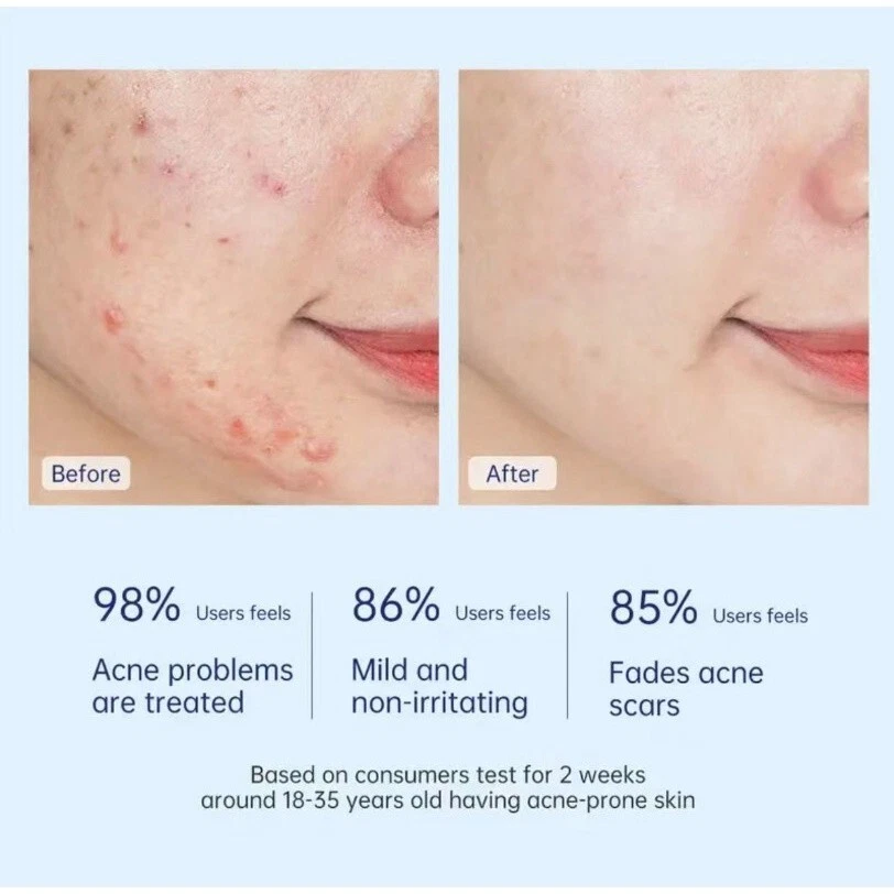 Salicylic Acid Spot Drying Lotion – Targeted Acne Care