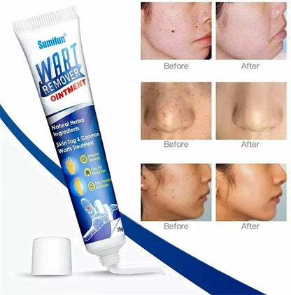 Wart Instant Blemish Cream Manufactured In Japan