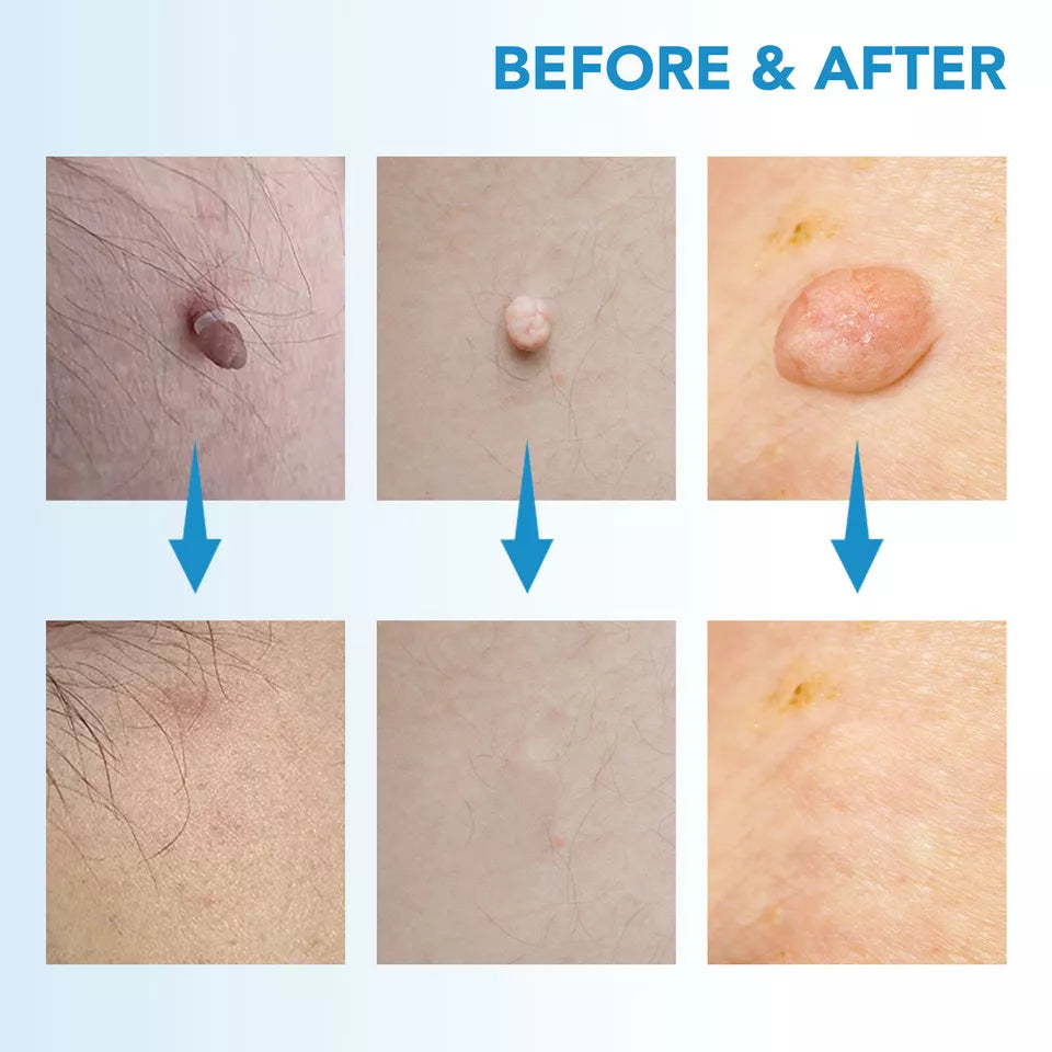 Auto Skin Tag Rapid Removal Kit