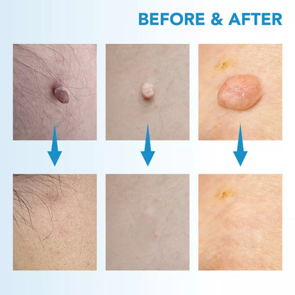 Auto Skin Tag Rapid Removal Kit