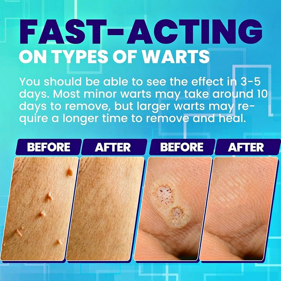 Skin Tag & Wart Remover Cream – Targeted Care for Smooth Skin