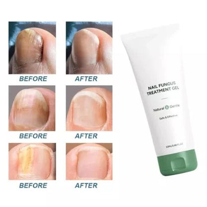Nail Fungus Treatment Gel – Restore Healthy & Clear Nails Fast