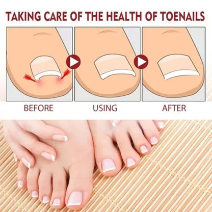 Nail Fungus Treatment Gel – Restore Healthy & Clear Nails Fast
